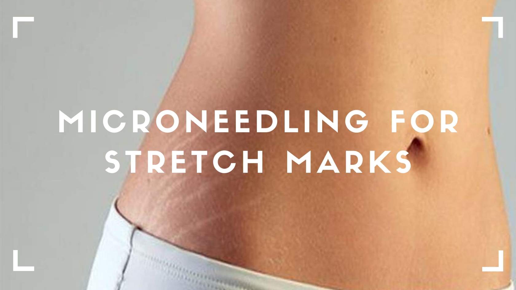 Microneedling for Stretch Marks