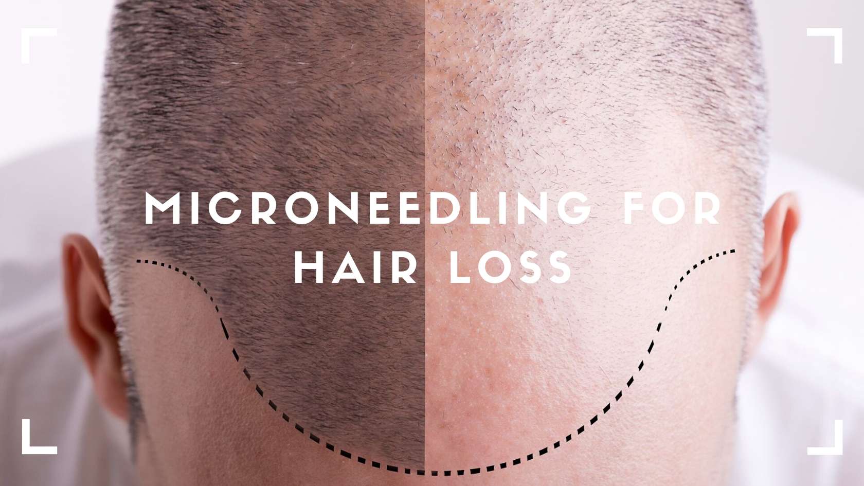 Microneedling for Hair Loss