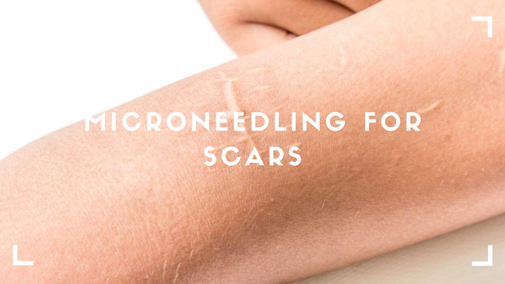Microneedling for Scars