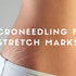 Microneedling for Stretch Marks