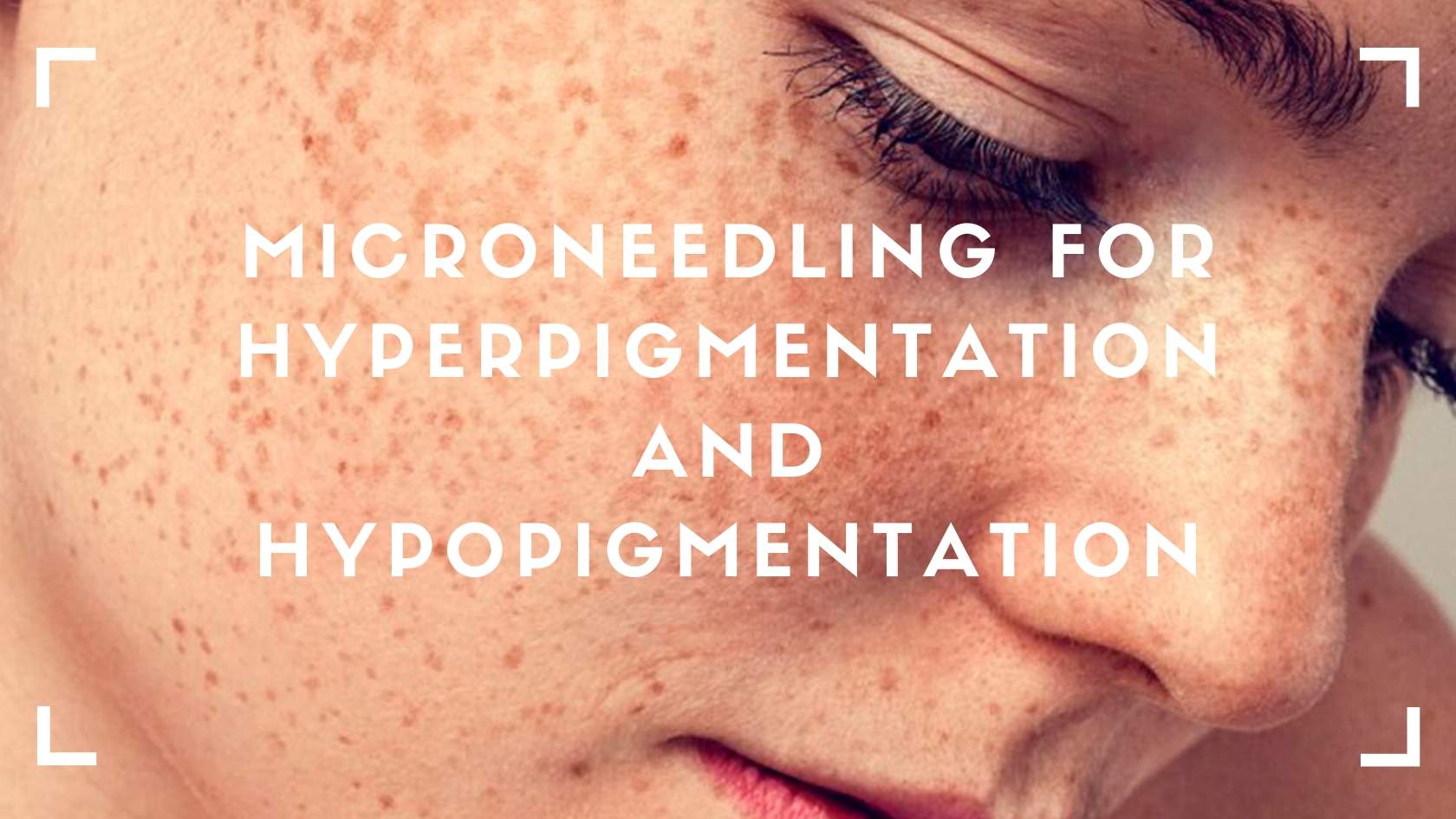 Microneedling for Hyperpigmentation and Hypopigmentation